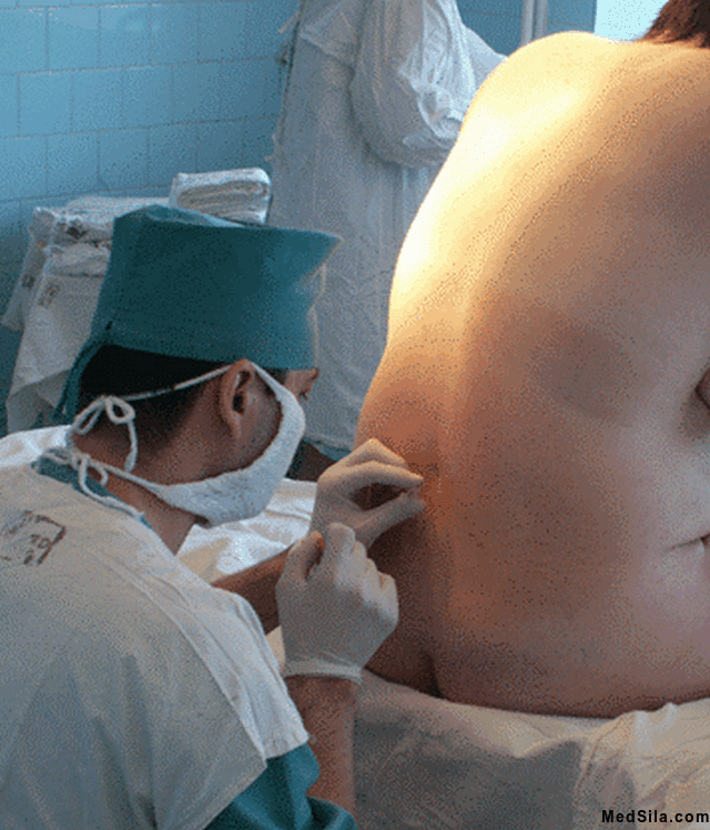 Положение во время спинальной анестезии